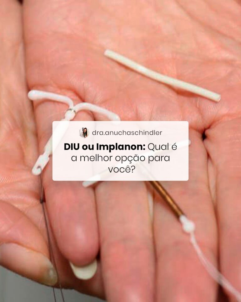 DIU ou Implanon: Qual é a melhor opção para você?